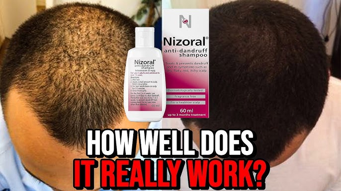 Ketoconazole Shampoo: Complete Guide for Healthy Scalp & Hair
